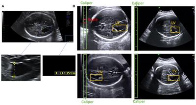 Automatic Measurements of Fetal Lateral Ventricles in 2D Ultrasound Images Using Deep Learning